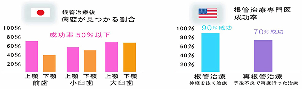 根管治療（Endoc®︎） - 仙台でインプラント、マウスピース矯正なら