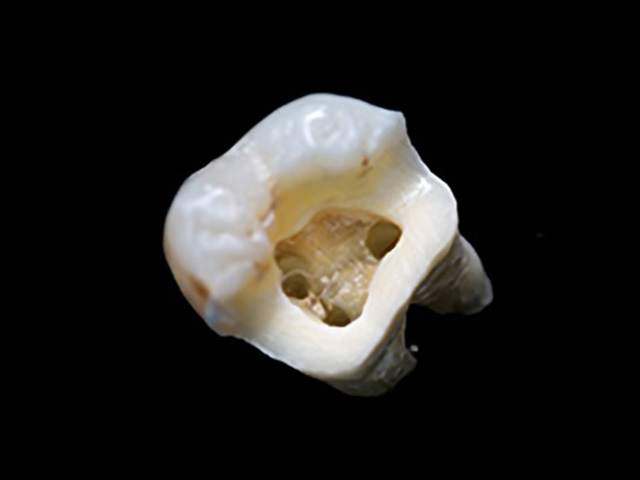 根管治療イメージ