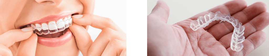インビザライン・アライナー