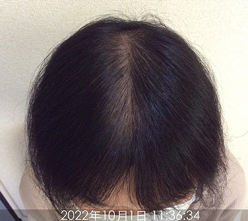 施術後②(4年4ヵ月後)