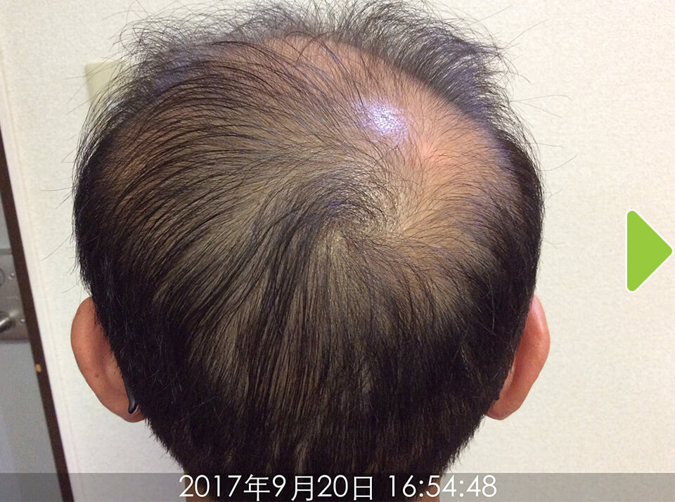 施術前(後頭部)