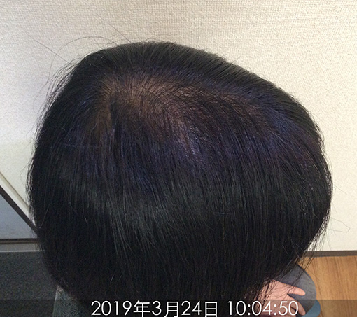 施術後①(約7ヵ月後)