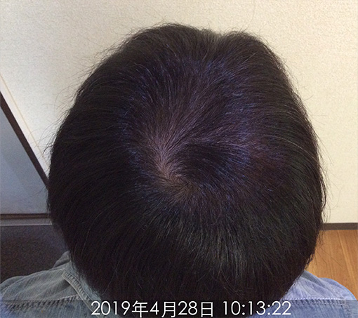 施術後(6ヵ月後)-3