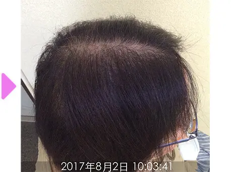 7ヵ月後（側面）