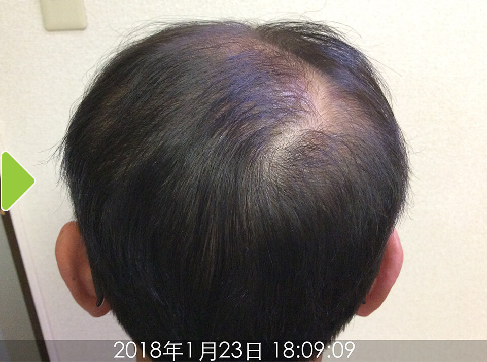 後頭部(4ヵ月後)