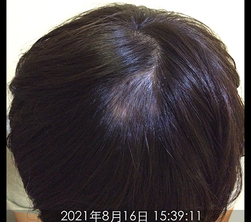 施術中-1ヶ月半後