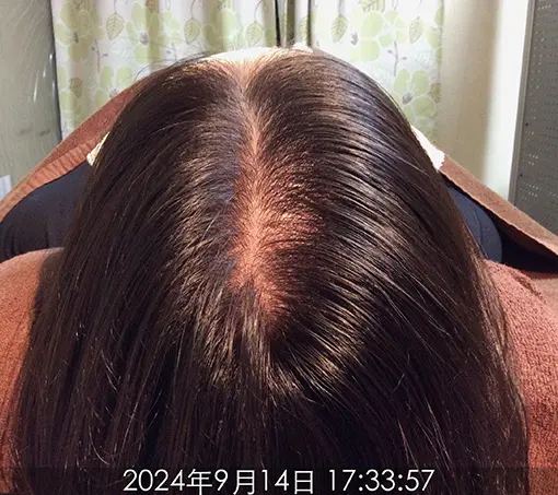 施術前-1