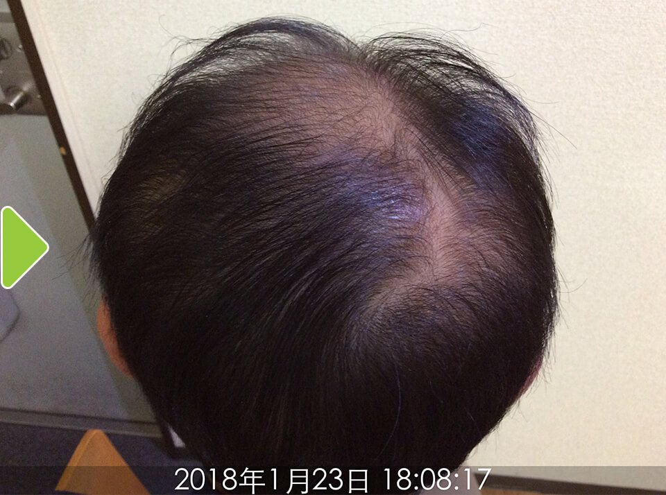 頭頂部(4ヵ月後)