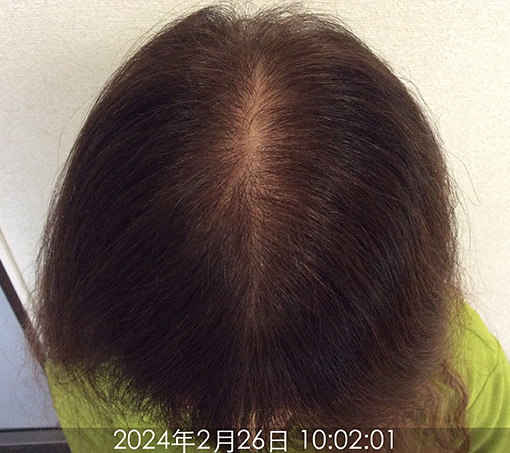 施術後①(約3ヵ月後)