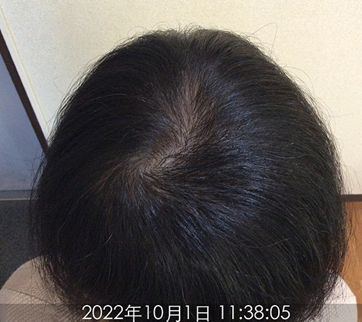 施術後③(4年4ヵ月後)