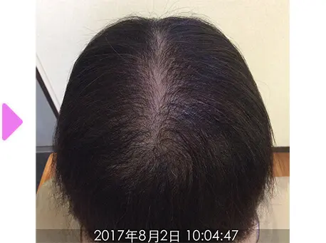 7ヵ月後（上部）