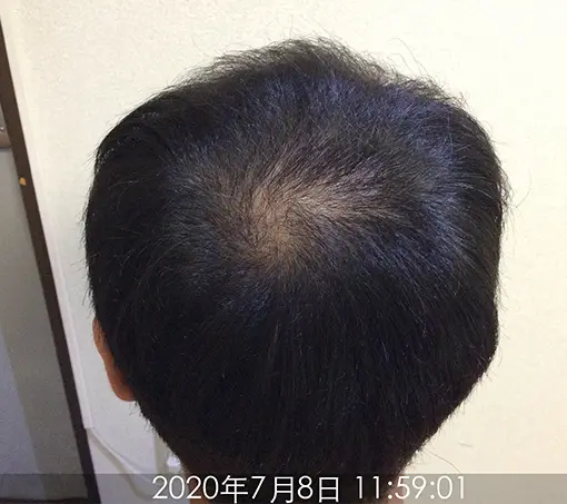 施術前