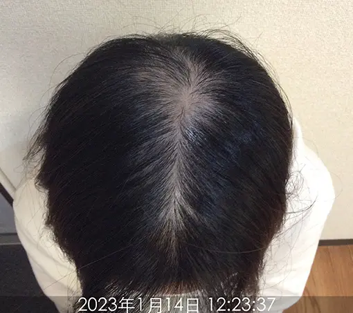 施術前-2