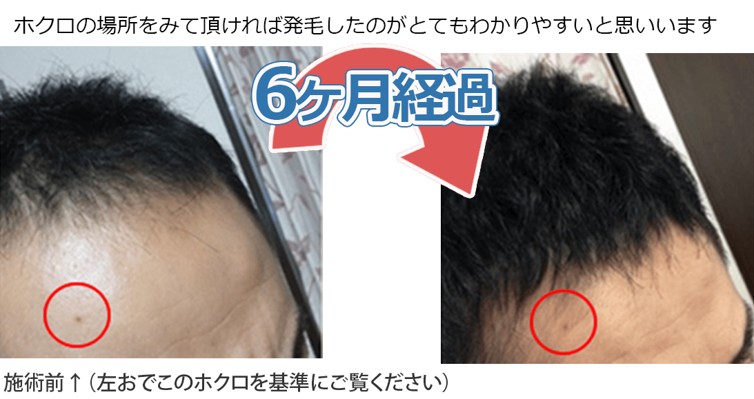 側面アングル 6ヶ月経過 センター長症例