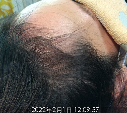 施術後1