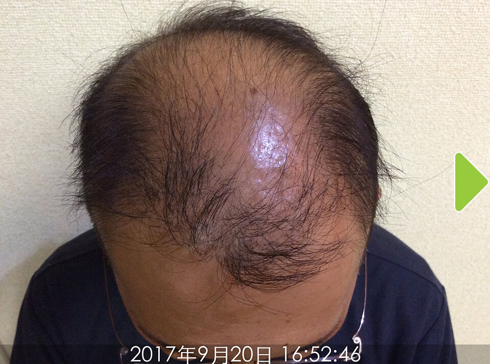 施術前