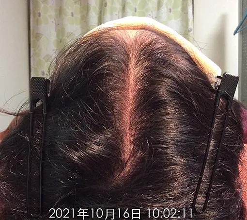 施術後