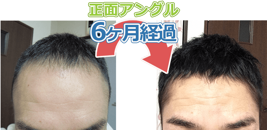 正面アングル 6ヶ月経過 センター長症例