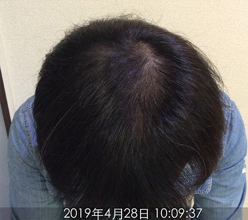 施術後(6ヵ月後)-1