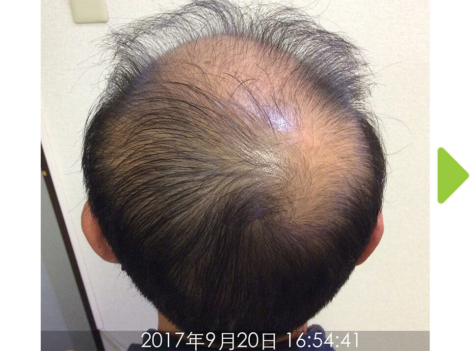 施術前(頭頂部)