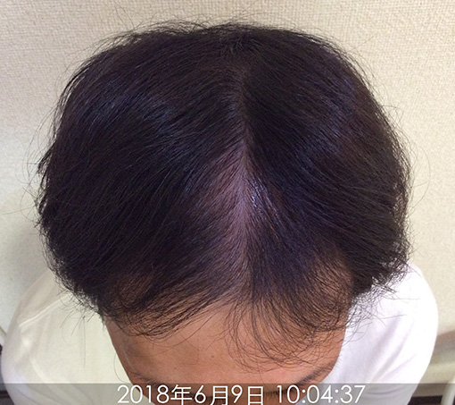 施術後-1