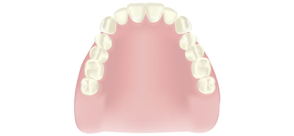 レジン床義歯（保険適応）