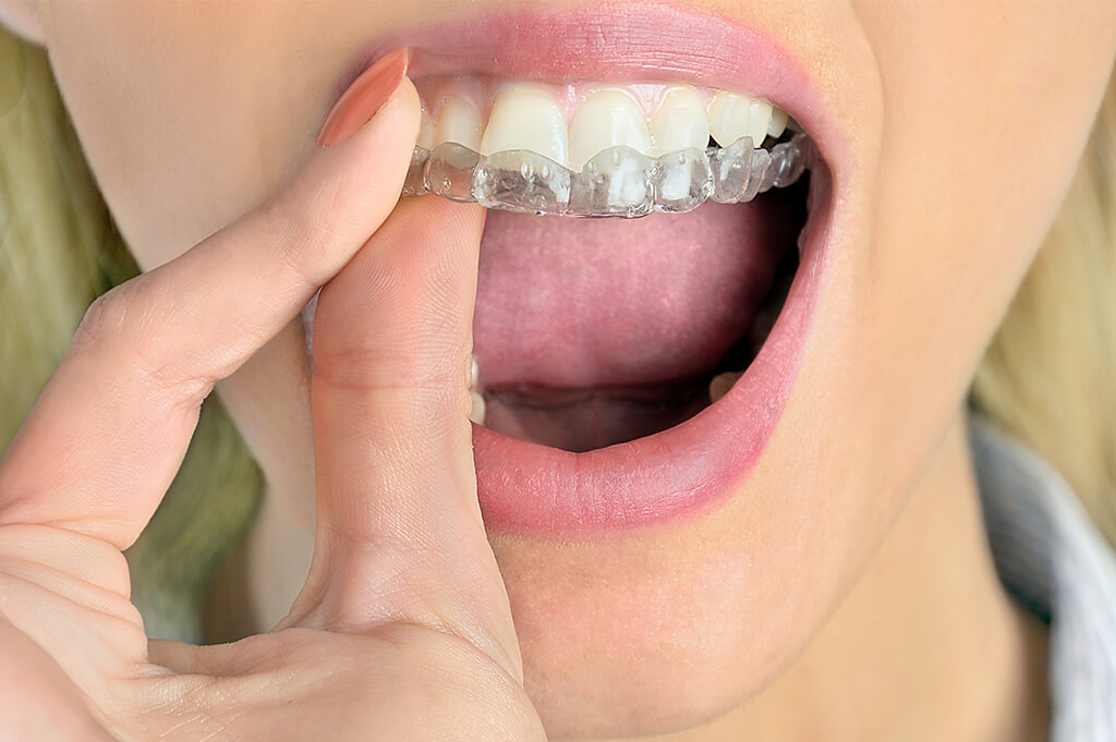 部分的な歯並び矯正装置　インビザライン GO
