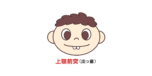 上顎前突（出っ歯）