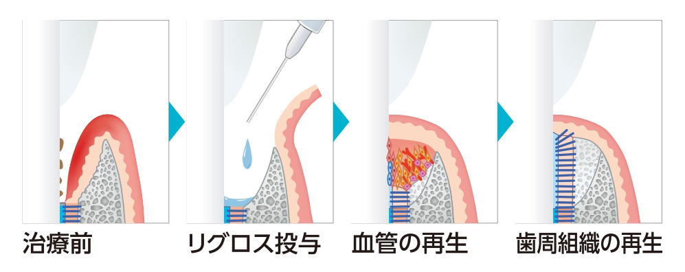 リグロス（歯周組織再生療法） - 医療法人 末永歯科医院 - 福島市の歯医者
