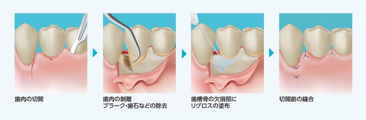 ＦＧＦ－２と歯周組織再生療法 リグロスの効果，手術のポイント，応用例 FGF-2と歯周組織再生療法