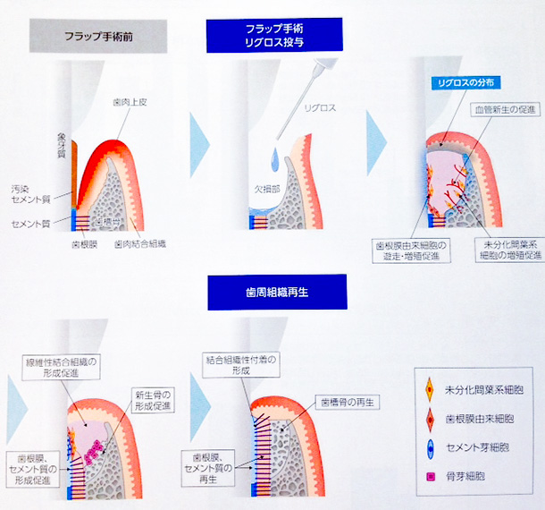 リグロスの歯周組織再生機序
