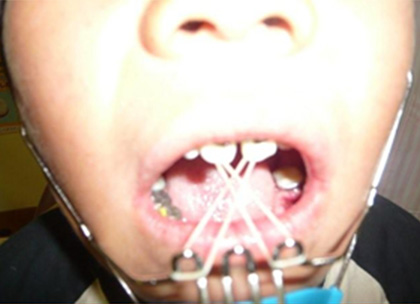 顎間ゴムによる上顎の牽引