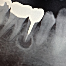 歯根嚢胞（中央の円形部分）