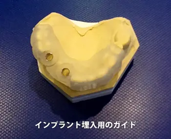 インプラント埋入用のガイド