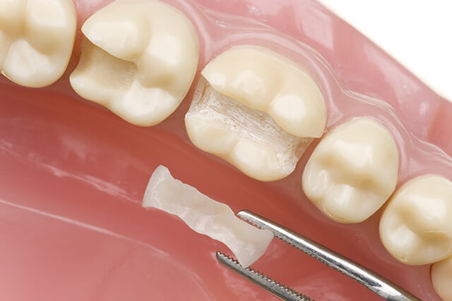 【C1 治療方法】虫歯を削る → 詰め物