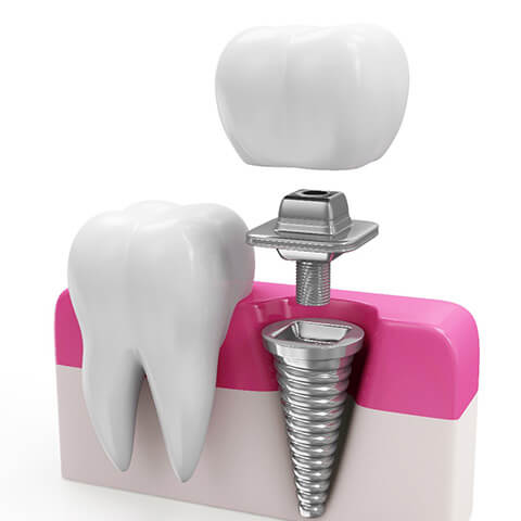 インプラントとは