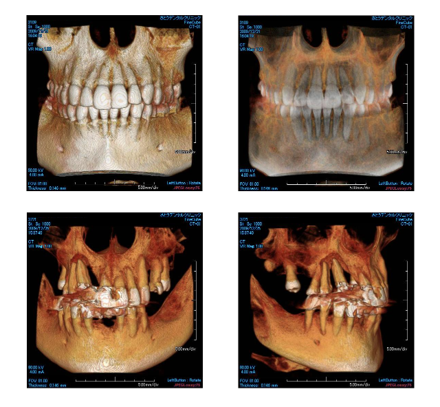 歯科用CT画像①