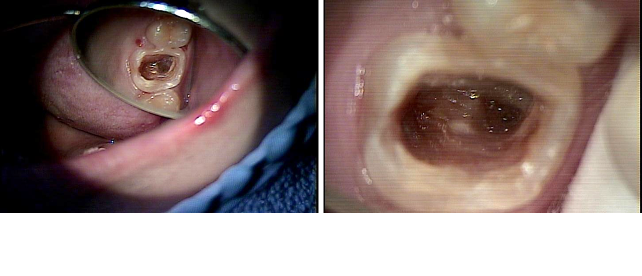 マイクロスコープによる根管の見え方比較