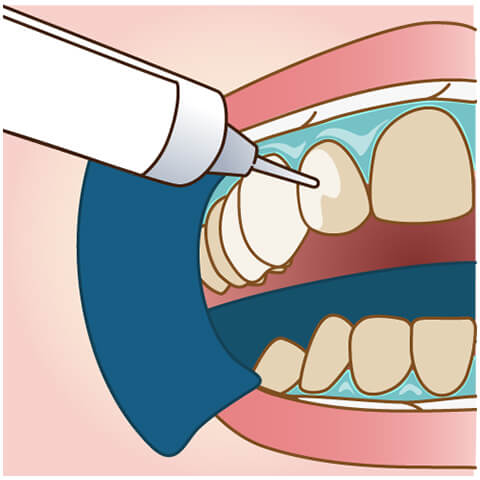 STEP3:歯の表面にホワイトニング剤を塗ります。