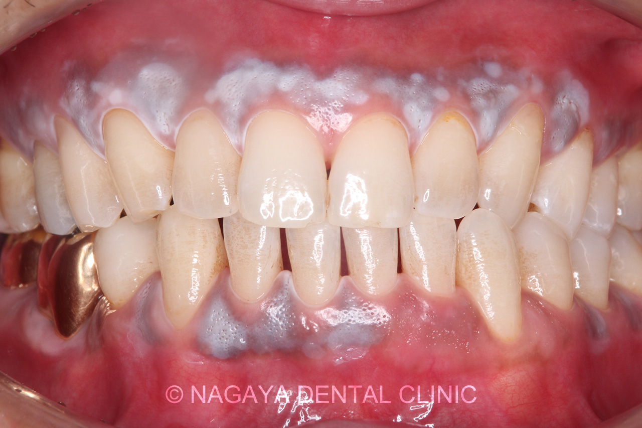 歯肉のホワイトニング施術中