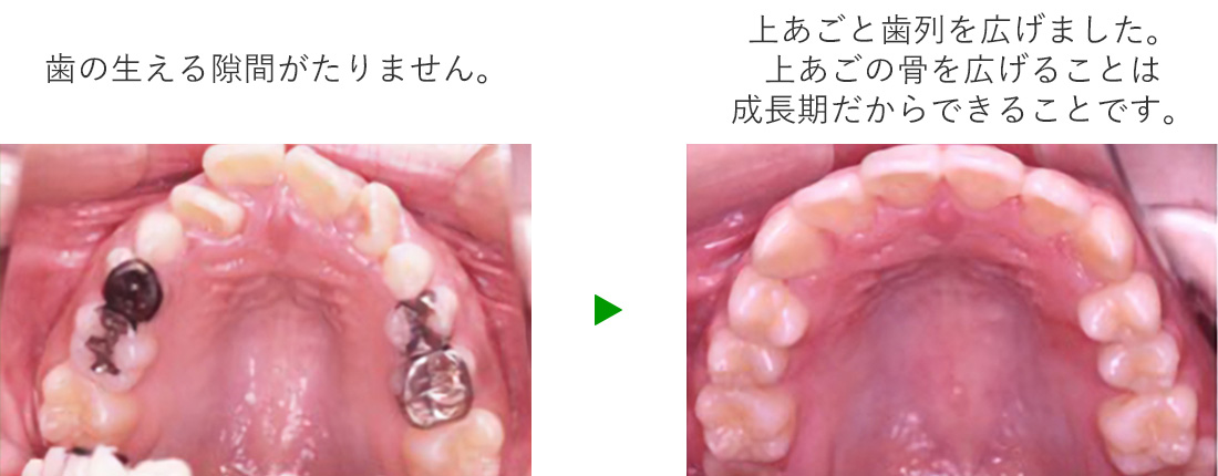 歯の生えるスペースの確保