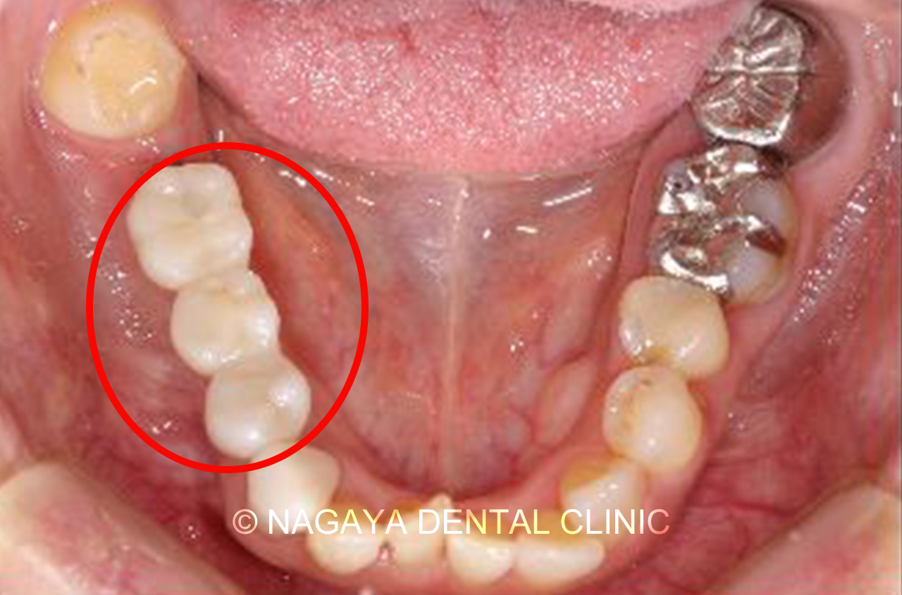インプラント症例 No.2(術後写真)