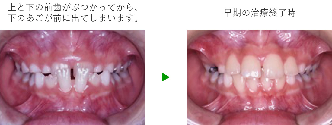 あごの骨の成長コントロール
