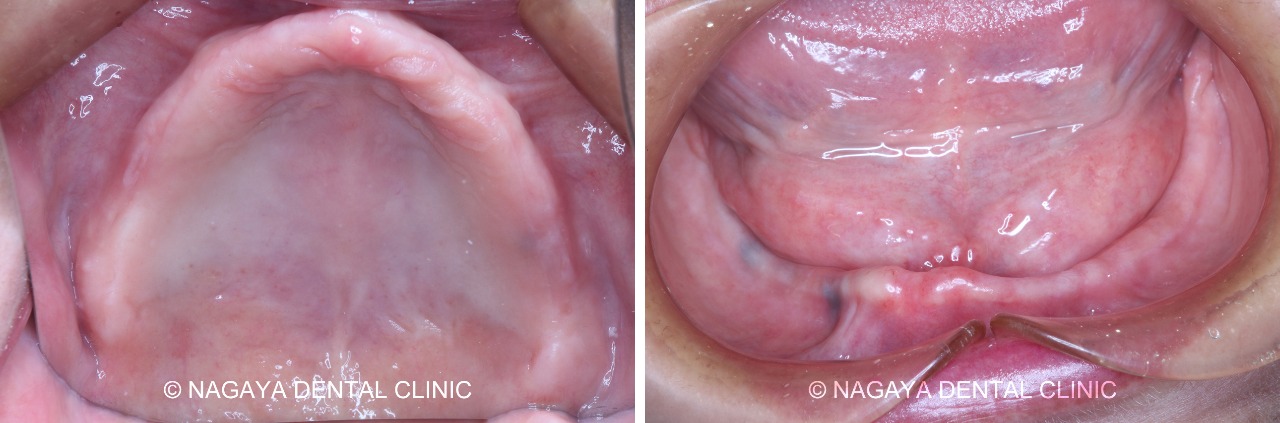 義歯(入れ歯)治療 No.1(義歯(入れ歯)を外したお口の中の様子)
