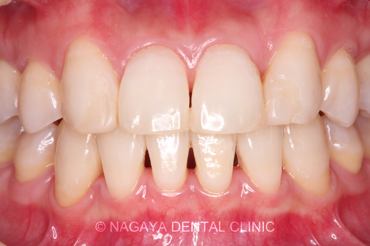 ホワイトニング症例 No.3(術後写真)