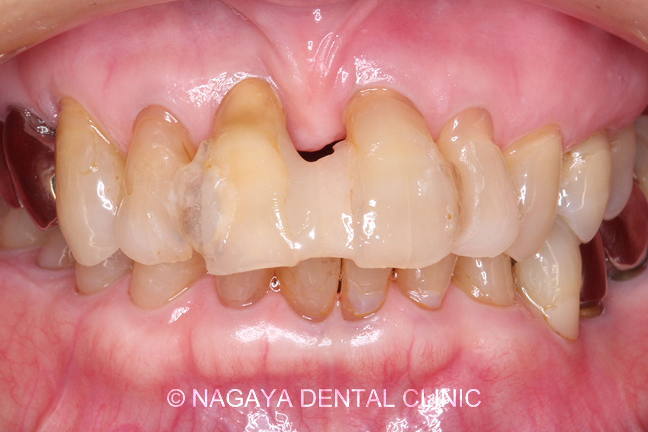 審美・セラミック治療症例 No.1(術前写真)