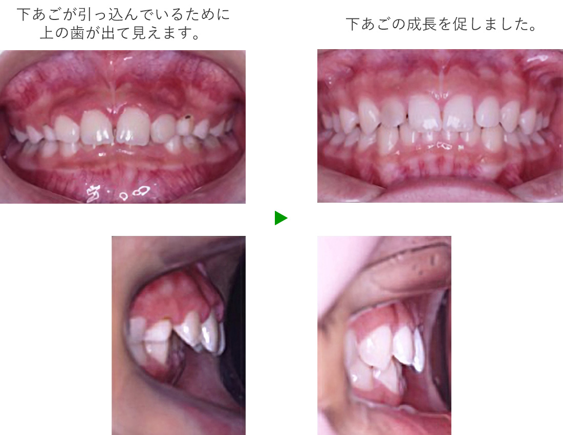 あごの骨の成長コントロール