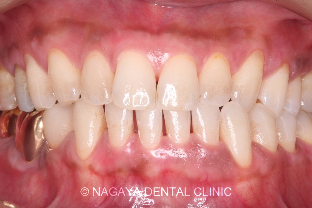歯肉のホワイトニング施術後