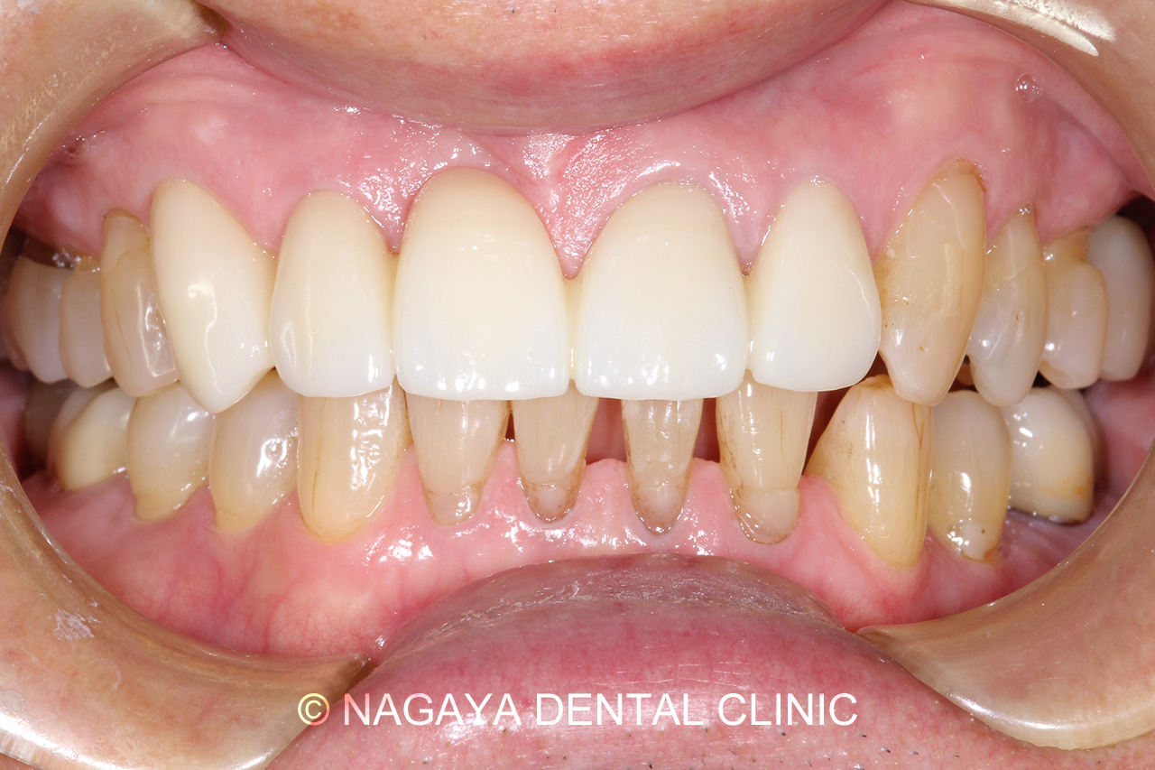 審美・セラミック治療症例 No.3(術後写真)
