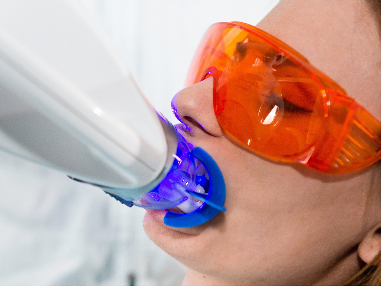 オフィスホワイトニング